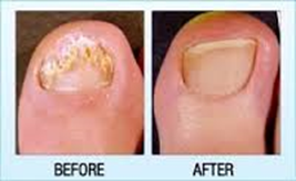 Toenail Laser Fungus Before After
