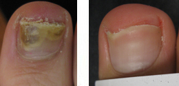 Toenail Before/After Laser