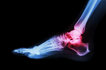 Hairline fracture: Symptoms, treatment, and causes