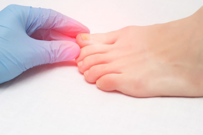 Doctor examines a sore toe infected with fungal infection, closeup