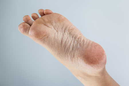 Home remedy for cracked heels: How to repair cracked heels? | HealthShots